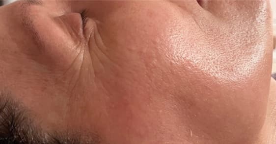 After — Close-up of the eye contour and cheek after a Skin Renewal Signature endermologie® treatment