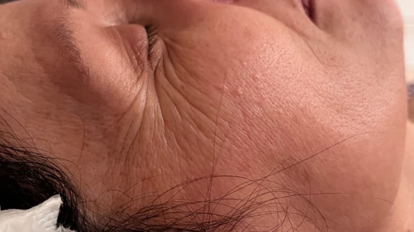Before — Close-up of the eye contour and cheek after a Skin Renewal Signature endermologie® treatment